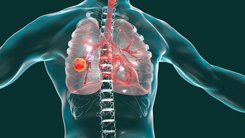 „Zdobywamy coraz lepsze zrozumienie”: Naukowcy odkrywają nową metodę zatrzymywania białek raka płuc