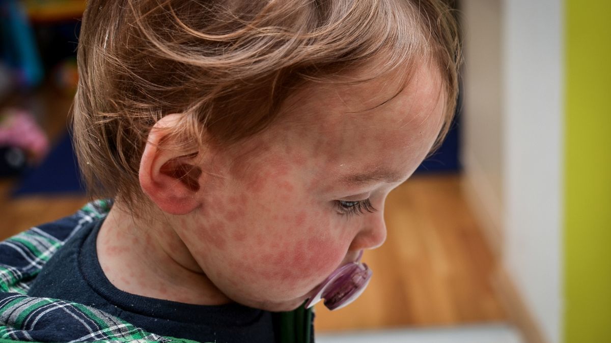 Baby with facial rashes.